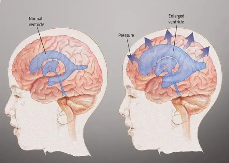 神外科普|脑水肿知识及临床救治